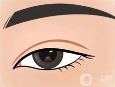 關(guān)于割雙眼皮容易出現(xiàn)哪些誤區(qū)？