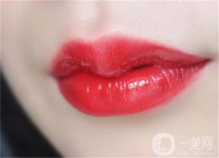 微笑唇部手術(shù)后需要幾天拆線？