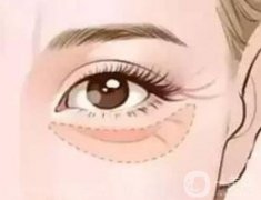 填充眼窩后恢復(fù)正常需要多長時間，流程是怎么樣的