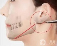 哪些因素影響磨腮削骨的愈合？