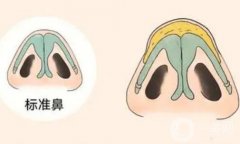 有哪些鼻翼縮小的手術(shù)方法？