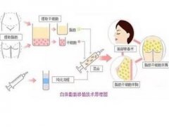 自體脂肪填充的怎么？