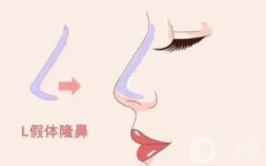 鞍鼻整形可以用什么材料？