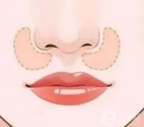 鼻基底填充手術(shù)的操作流程是怎么樣的？
