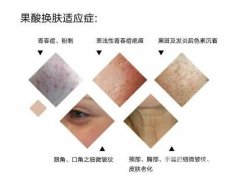 果酸換膚調(diào)節(jié)的間隔時間是多久？