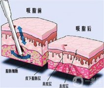 光纖溶脂和吸脂的區(qū)別是什么？