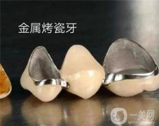 貴金屬烤瓷牙的價格一般是多少？
