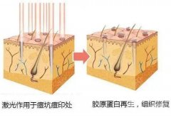 做激光點陣疼嗎，可以用麻藥嗎？