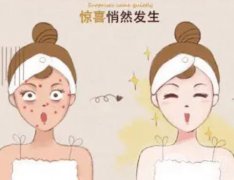 黃褐斑是怎么形成的？怎么去除