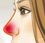 酒渣鼻怎么調(diào)節(jié)？病因是什么？