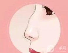 駝峰鼻的分類(lèi)及矯正方法?
