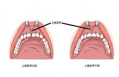 唇系帶整形手術的方法和步驟？
