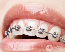 固定矯治器調(diào)節(jié)的優(yōu)勢(shì)？注意事項(xiàng)？
