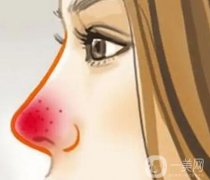 酒渣鼻的成因是什么？發(fā)病率高嗎
