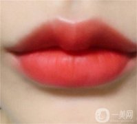 隆唇手術(shù)一般需要多少錢？玻尿酸隆唇后可以接吻嗎？