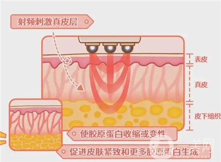 熱瑪吉電波拉皮*果怎么樣？維持多久？