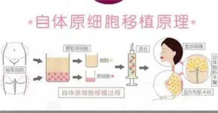 臉部脂肪填充后遺癥有哪些 臉部脂肪填充后臉會僵硬嗎