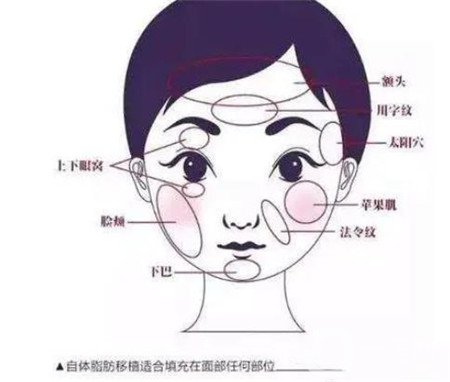 臉部自體脂肪填充價(jià)格一般是多少？*果好不好？