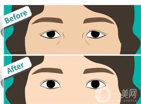 埋線雙眼皮修復(fù),埋線雙眼皮修復(fù)價(jià)格