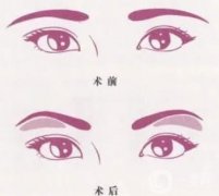 切眉手術(shù)后是不是衰老很快？