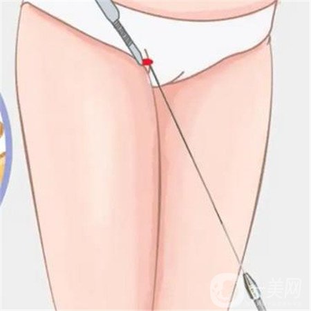 等離子光纖溶脂有危害嗎 有什么危害呢？