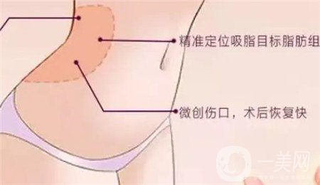 全身吸脂手術價格？馮斌做全身吸脂大概多少錢？
