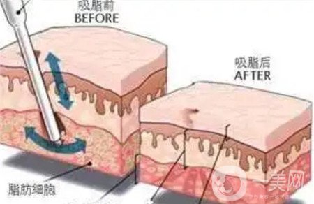 全身吸脂手術價格？馮斌做全身吸脂大概多少錢？