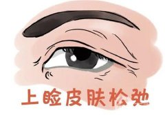 為什么眼皮會(huì)下垂？如何自我矯正？