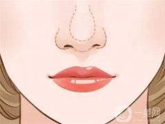 手術(shù)需要多少錢？注意事項有哪些？