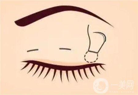 濟南隅美整形醫(yī)院怎么樣?雙眼皮真實案例和價格表一覽