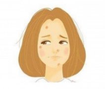 痘印可以用去除嗎？做完后需要加強防曬嗎？