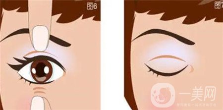 山東省立醫(yī)院開(kāi)眼角多少錢(qián)?附2020整形價(jià)格表及案例