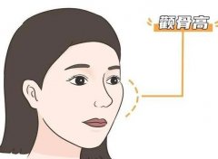 下頜角截骨術(shù)有哪些特點和風險？適合哪個年齡？