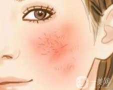 光子嫩膚去紅血絲要多少錢？