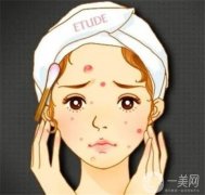 有哪些類型的？做激光會損傷皮膚嗎？