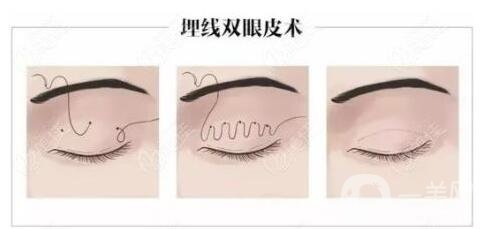 拉雙眼皮的危害是什么？術后注意事項有哪些？
