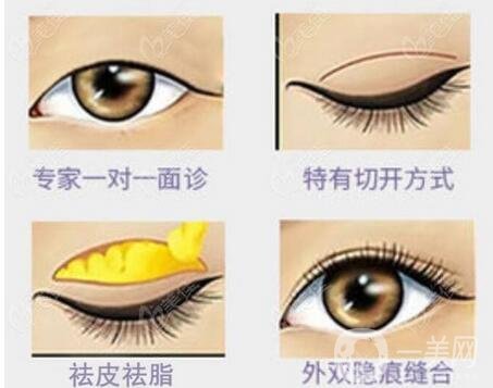 開眼角,開眼角價格,重慶開眼角價格