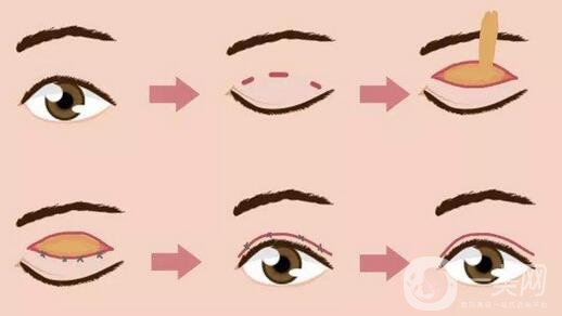 北京埋線雙眼皮修復(fù)價(jià)格盤(pán)點(diǎn)