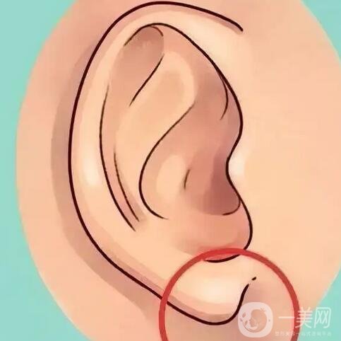 玻尿酸注射豐耳垂要注意什么？術(shù)后護理詳細介紹