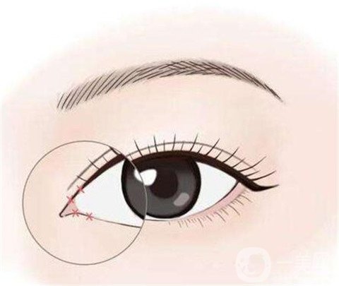 開內(nèi)眼角多久可以化妝？