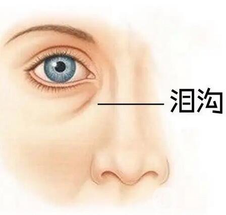玻尿酸填充淚溝維持時(shí)間,玻尿酸填充淚溝