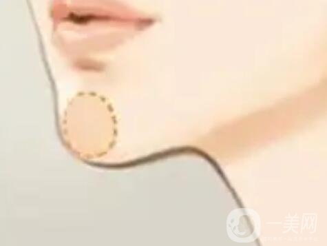 墊下巴術(shù)前準備有什么呢？