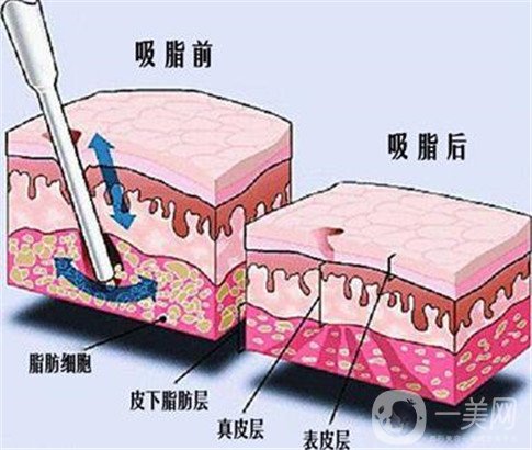 360環(huán)形抽脂手術大概要多少錢？