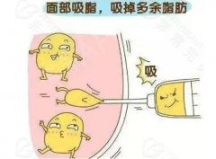 成都面部吸脂多少錢?價格影響因素大盤點