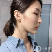 我之前其實(shí)也有去做過豐下巴，我之前是玻尿酸注射，一開始的效果還算是可以