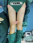 自從在醫(yī)院做了大腿吸脂手術(shù)以后，我終于擁有了兩條纖細(xì)筆直的漫畫腿