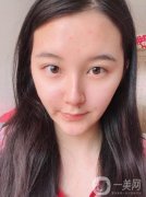 在整個(gè)過(guò)程中不會(huì)感覺(jué)到什么疼痛，現(xiàn)在熱瑪吉已經(jīng)發(fā)展到第五代了