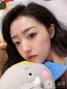 醫(yī)生也是建議本人做個拉皮的項目，看了許多案例，感覺做出來效果相當不錯