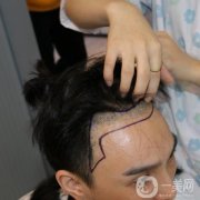 在朋友推薦之下，我終究還是做了植發(fā)手術(shù)，經(jīng)過(guò)長(zhǎng)期以來(lái)的生長(zhǎng)