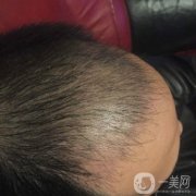 而我也是在這個(gè)時(shí)候出現(xiàn)的嚴(yán)重脫發(fā)，而且我覺得自己的情況要比當(dāng)初的爸爸更